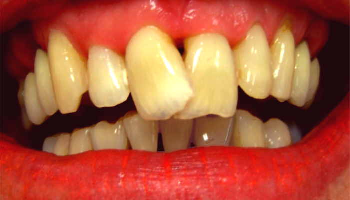 ارتودنسی دندان,ایمپلنت بهتر است یا کامپوزیت,بعد ارتودنسی