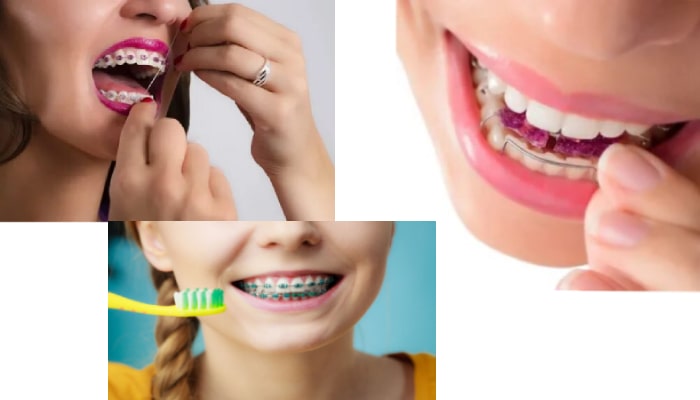 عدم رعایت بهداشت دندان ها باعث بازگشت درمان ارتودنسی می شود