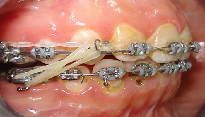 ماندگاری درمان ارتودنسی دندان
