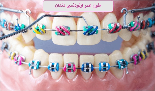 طول عمر ارتودنسی دندان چقدر است