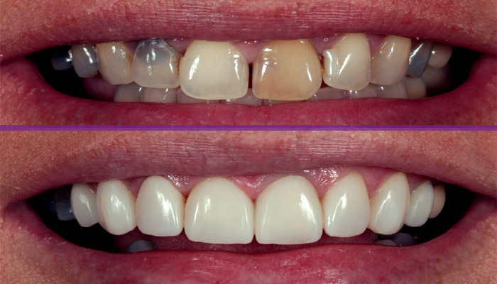 اصلاح ظاهر دندان با کامپوزیت