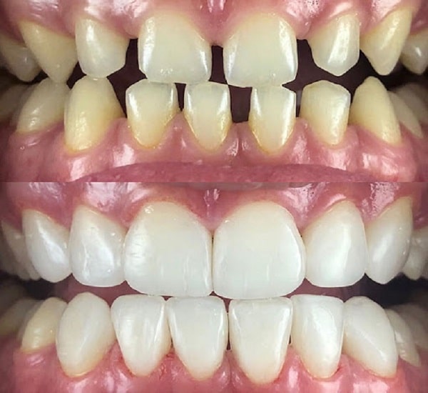 دندان قدامی کامپوزیت شده نیز می تواند ۵ تا ۷ سال دوام داشته باشد