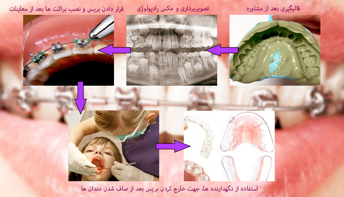 عکس مراحل انجام ارتودنسی دندان