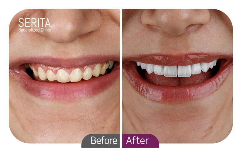 قبل و بعد از لمینت کلینیک سریتا