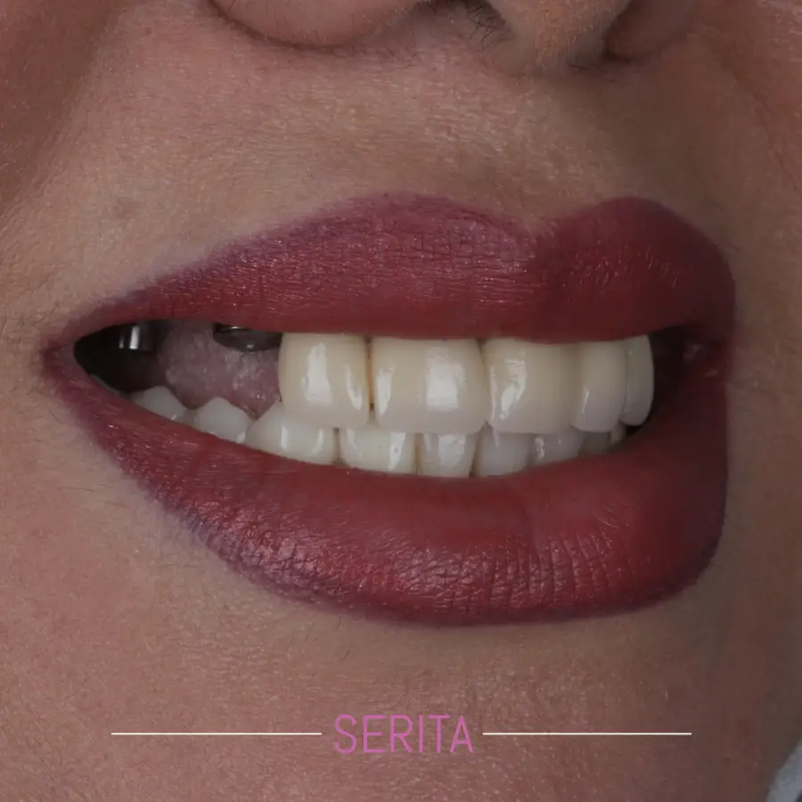نمونه کار ایمپلنت دندان