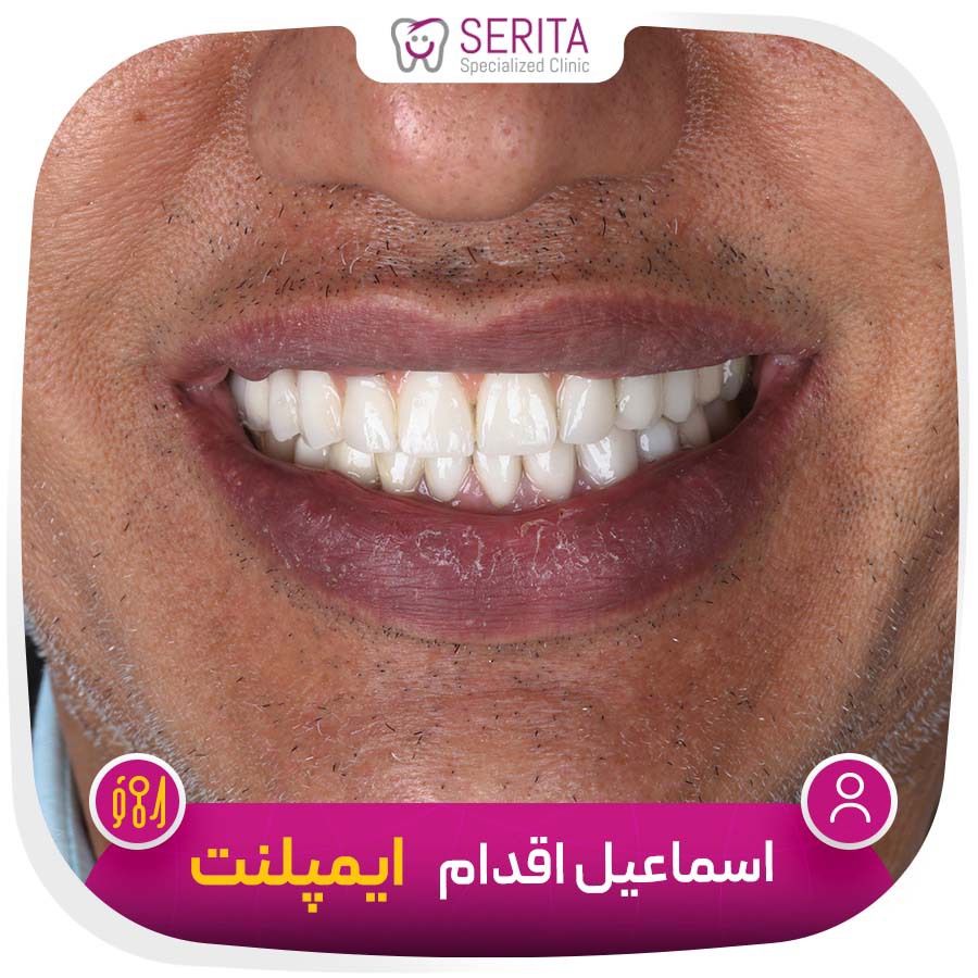 نمونه کار ایمپلنت دندان