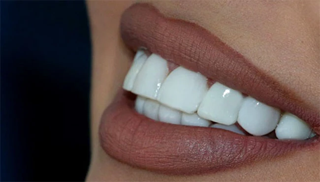 لمینت دندان یک راه حل ماندگار برای درمان سیاه شدن دندان است با لمینت دندان به راحتی سیاهی دندان برطرف می شود