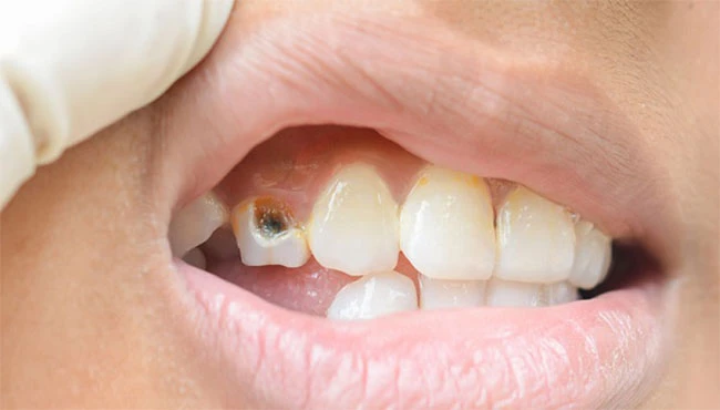 پوسیدگی دندان باعث سیاه شدن دندان و ایجاد لکه های تیره روی دندان می شود.