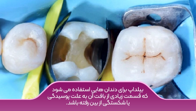 بیلداپ (buildup) برای دندان هایی استفاده می شود که دچار آسیب شده اند. مانند پوسیدگی و ...