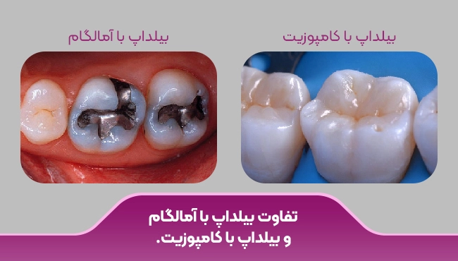 تفاوت بیلداپ دندان با آمالگام و کامپوزیت