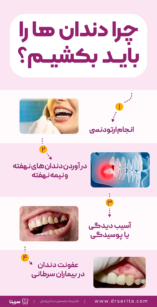 علل کشیدن دندان، 4 دلیل برای کشیدن دندان