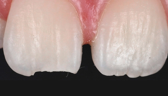 با مشکل شکستن کامپوزیت دندان چه کنیم؟