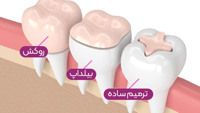 انواع ترمیم های دندانی، تفاوت و مقایسه ترمیم، بلیداپ و روکش