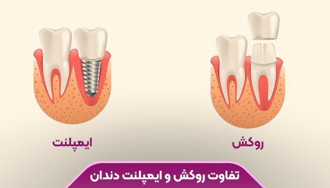 تفاوت روکش و ایمپلنت دندان، ایمپلنت ماندگاری بسیار بیشتری دارد اما گرانتر است.