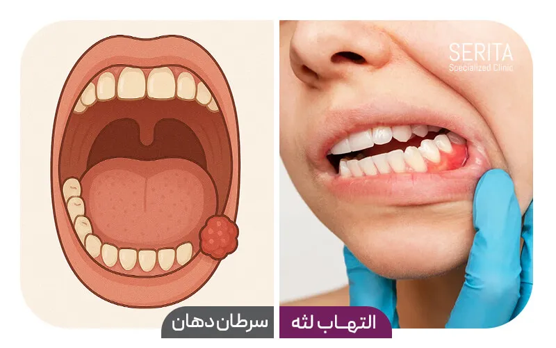 تفاوت التهاب لثه و سرطان دهان