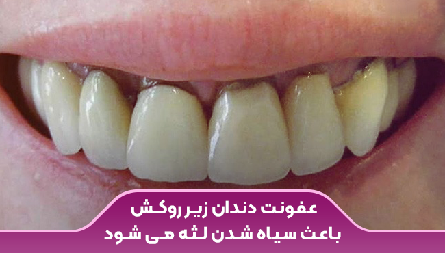 عفونت دندان زیر روکش باعث سیاه شدن لثه می شود.