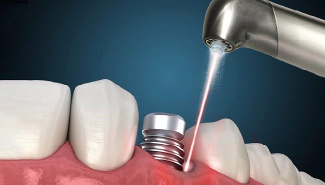 چگونه بدون جراحی دندان های خود را ایمپلنت کنیم؟
