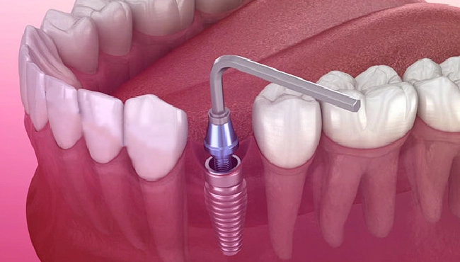 چگونه بدون جراحی دندان های خود را ایمپلنت کنیم؟
