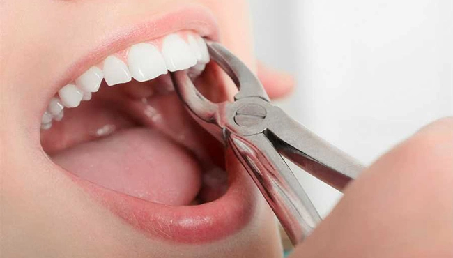 کشیدن دندان به روش ساده