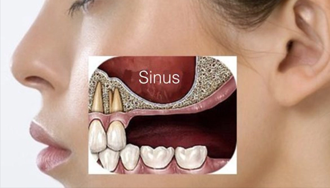 حفره های سینوس و  آسیب به سینوس (سوراخ شدن سینوس) در عصب کشی یا کشیدن دندان