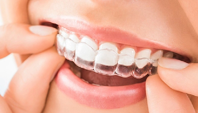 با مشکل شکستن کامپوزیت دندان چه کنیم؟