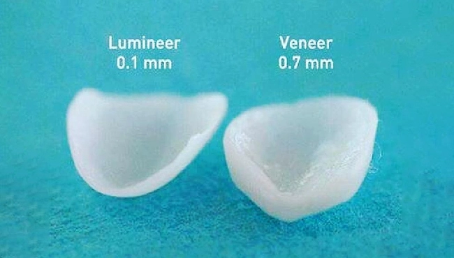 طول عمر لمینت دندان چند سال است؟