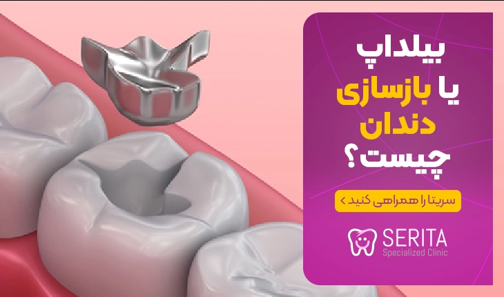 بیلداپ یا بازسازی دندان چیست؟