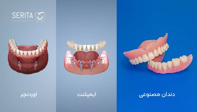 مقایسه دندان مصنوعی، ایمپلنت و اوردنچر
چه تفاوتی هایی دارند.