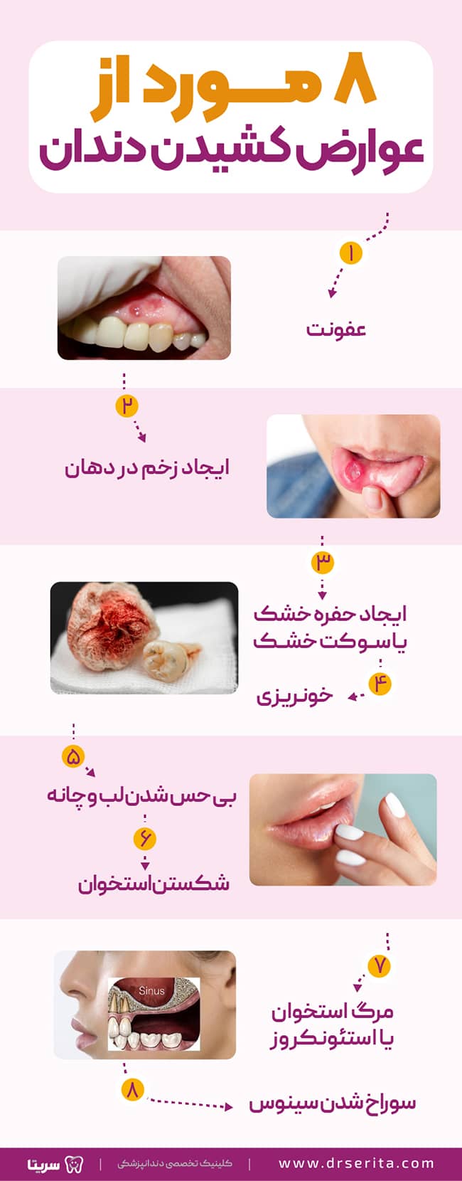 8 مورد از عوارض کشیدن دندان
