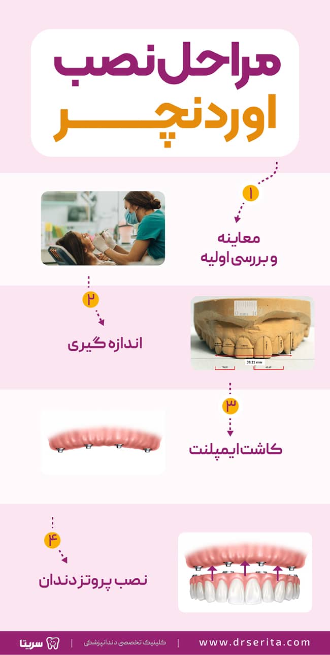 مراحل کامل نصب اوردنچر دندان، اوردنچر دندان چگونه در دهان قرار میگیرد. 4 مرحله نصب اوردنچر