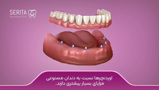 ساختار اوردنچرها، اوردنچر نسبت به دندان مصنوعی برتری دارد.