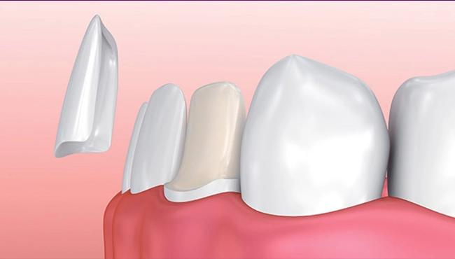 روش اتصال لمینت emax به دندان