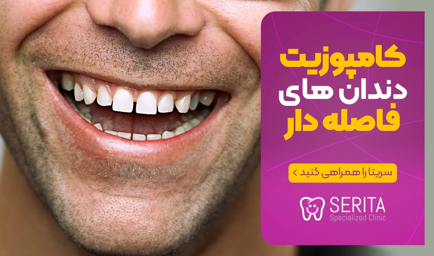 درمان فاصله بین دندان ها با کامپوزیت دندان