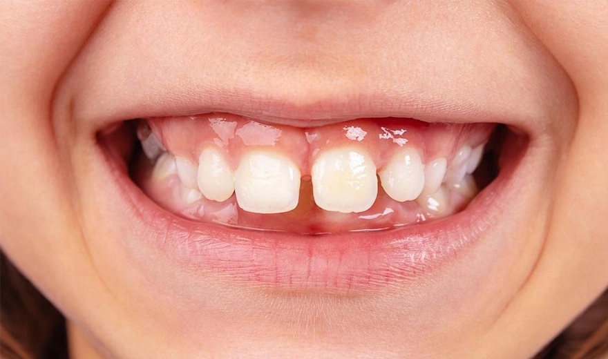 علت ایجاد فاصله بین دندان های کودکان، دلایل دیاستم دندان در کودکان