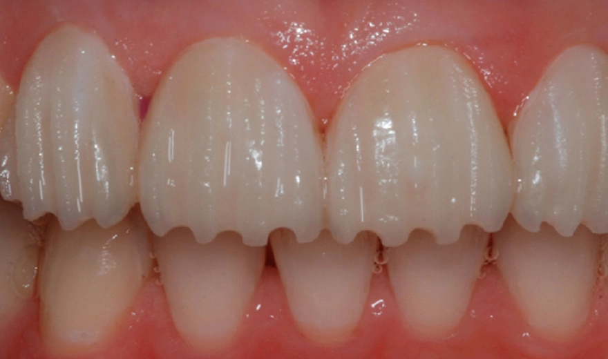 تراش دندان برای نصب لمینت دندان