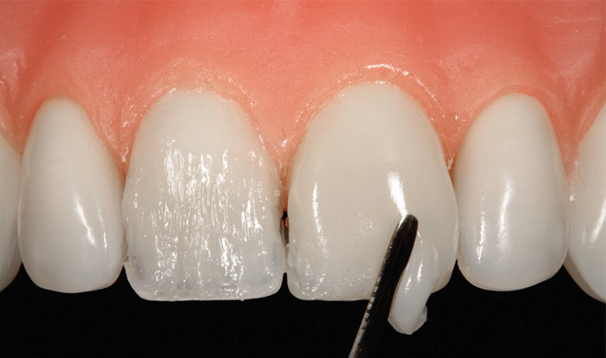 مرحله فرم دهی کامپوزیت دندان در کلینیک سریتا