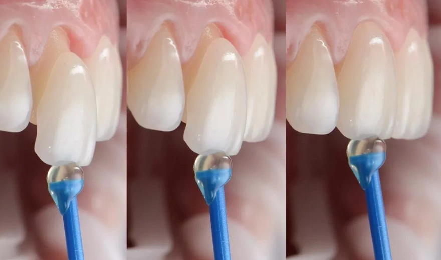 مراحل لمینت دندان، چسباندن لمینت دندان به دندان متقاضی در کلینیک سریتا