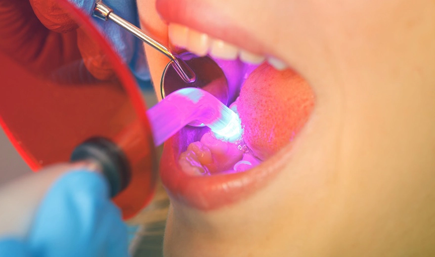چسب دندان موقت چسب دندان دائمی انواع چسب دندانپزشکی