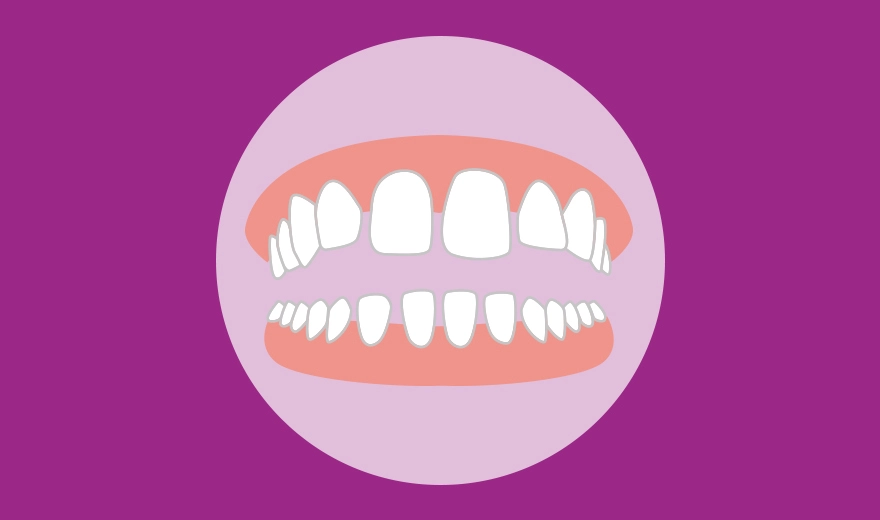 رفع مشکل فاصله بین دندان ها با لمینت دندان