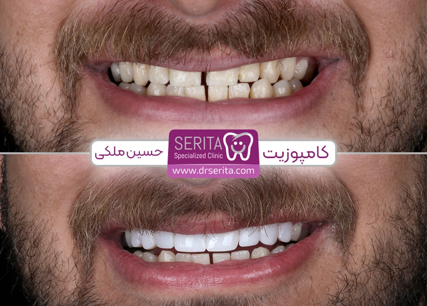 رضایت مشتری و نمونه کار انجام شده کامپوزیت دندان در کلینیک سریتا آقای حسین ملکی