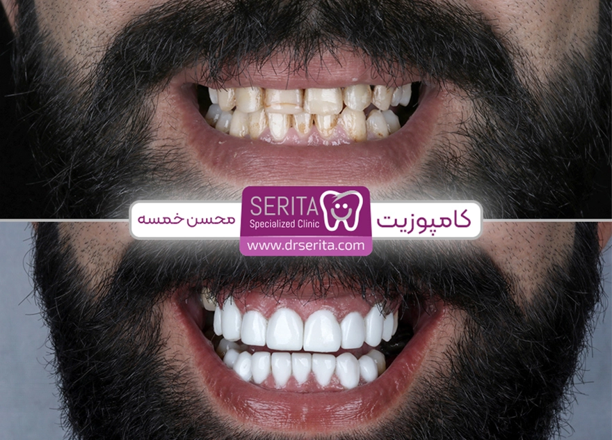 رضایت از انجام کامپوزیت دندان در کلینیک سریتا