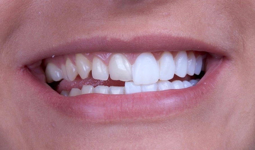 سایر روش های درمان فاصله بین دندان ها