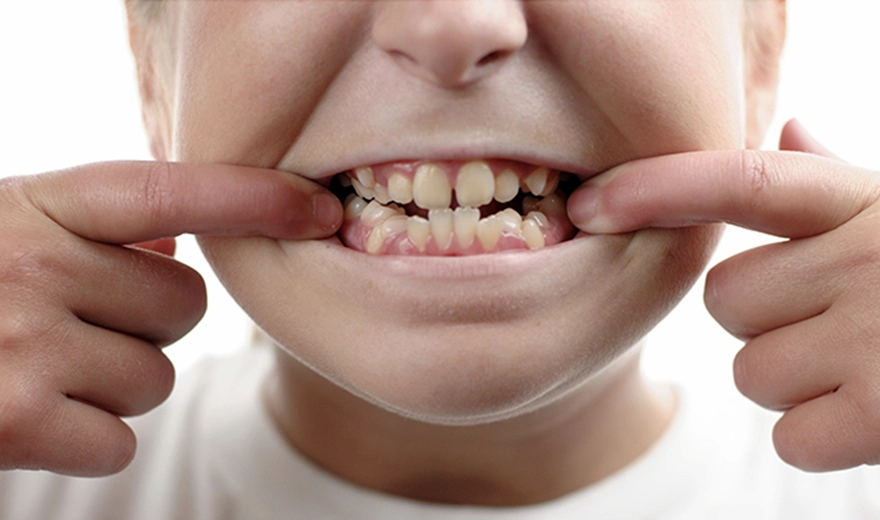 معایب فاصله بین دندان در کودکان