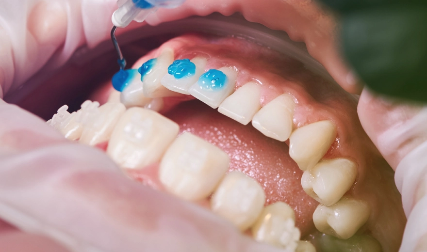ترکیبات چسب دندان، انواع چسب دندانپزشکی بر اساس ترکیب مواد
