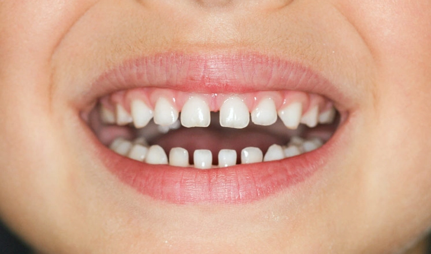 فاصله بین دندان های شیری در کودکان