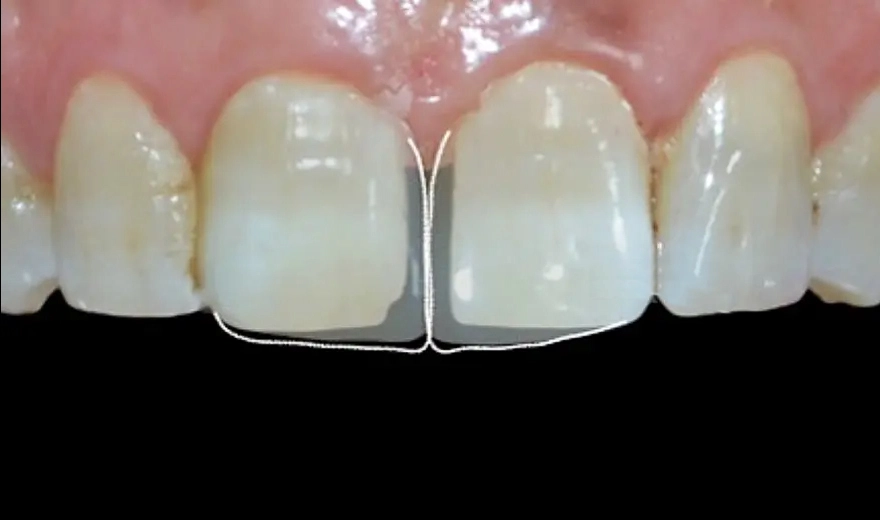 از بین بردن دیاستم و فاصله بین دندان ها با کامپوزیت دندان