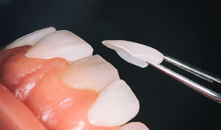 لمینت دندان راهی برای درمان فاصله بین دندان هاست