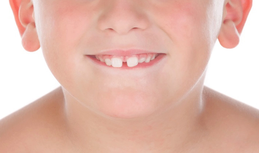 فاصله و دیاستم بین دندان های کودکان به همراه راه های درمان