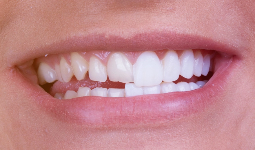 نمونه لمینت دندان کج زیبایی دندان کج
