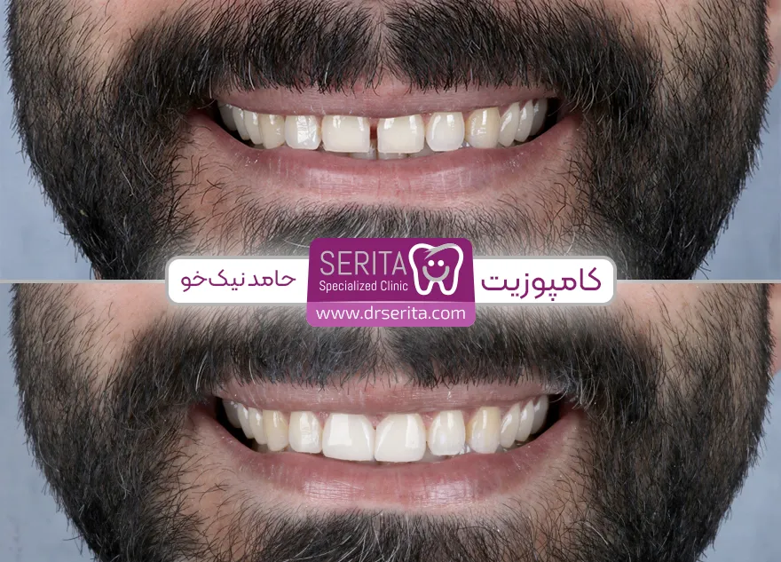 نمونه کار قبل و بعد کامپوزیت دندان حامد نیک خو کلینیک سریتا